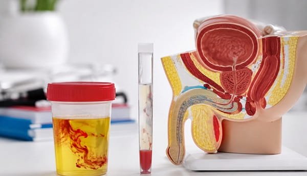 Blood in Urine or Semen: When Could It Indicate Prostate Cancer?